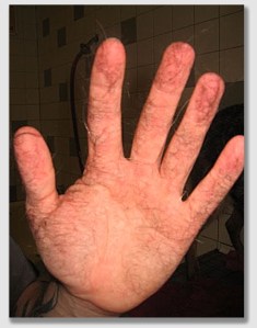 Hawkins v. McGee - the case of the hairy hand